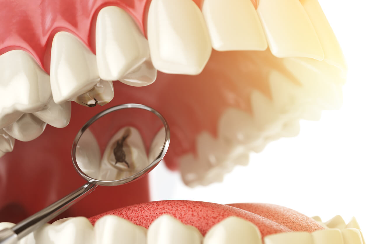 Signs of Tooth Decay You Shouldn't Ignore - Binder Family Dental