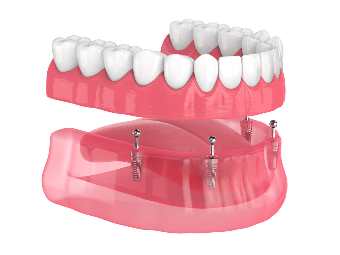 Are invisible braces the right solution for me? - Binder Family Dental